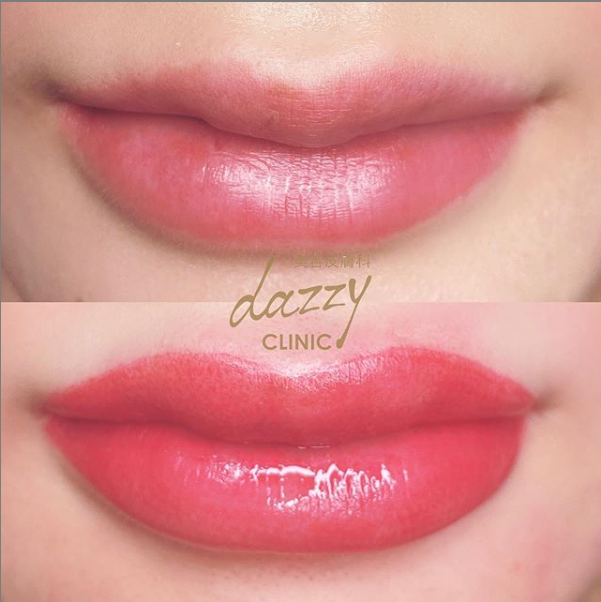 デイジークリニック症例リップ