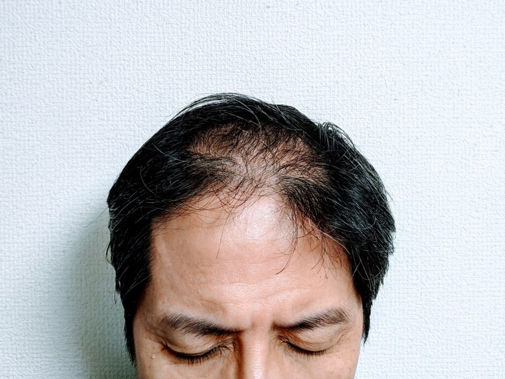 脱毛症 男性