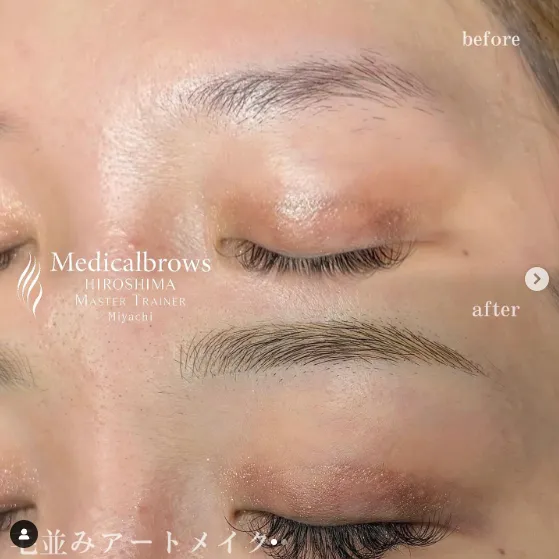 メディカルブロー 眉毛 アートメイク 症例