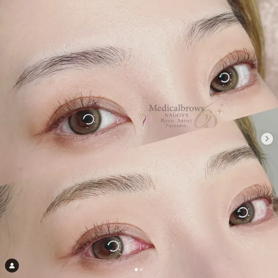 メディカルブロー 眉毛 アートメイク 症例