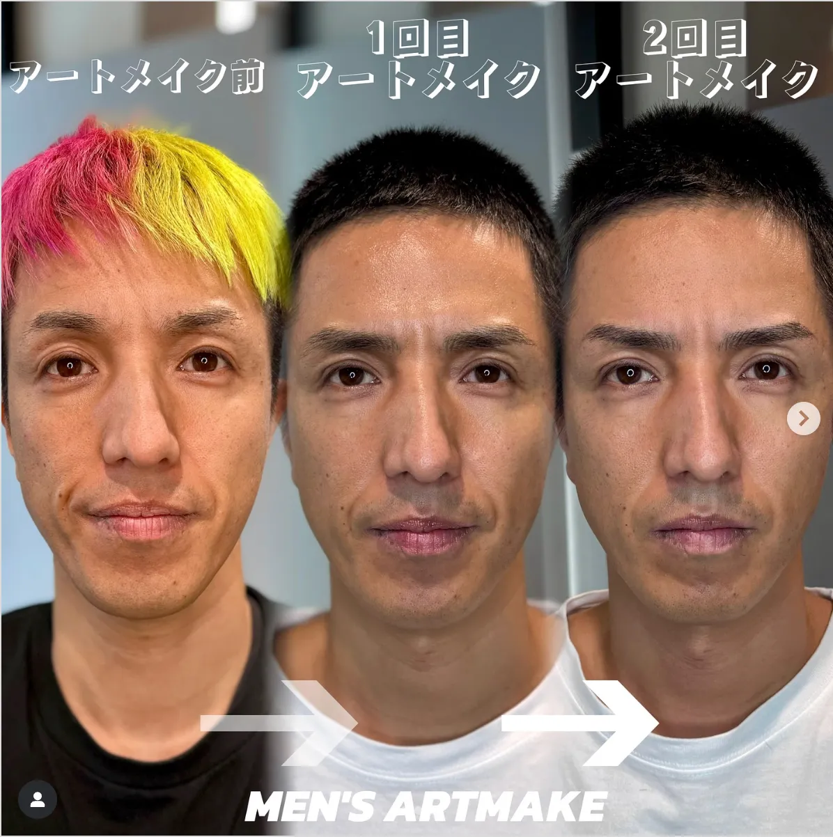 メンズアップ眉毛アートメイク症例