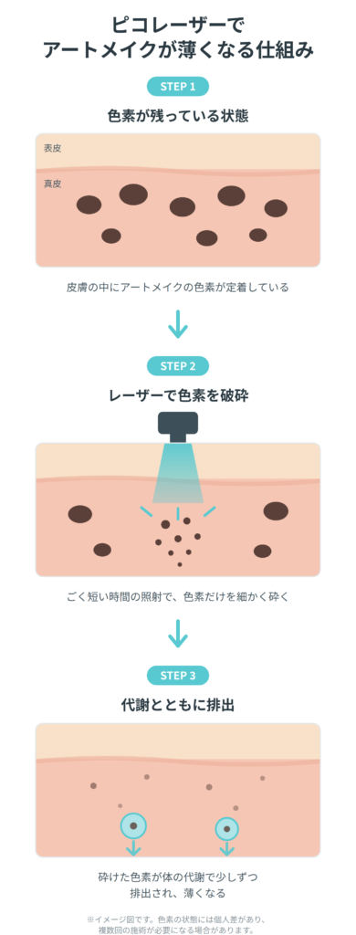 アートメイク除去　仕組み　レーザー